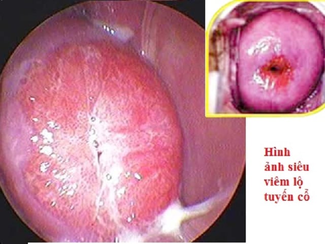 Các giai đoạn phát triển của bệnh viêm lộ tuyến cổ tử cung