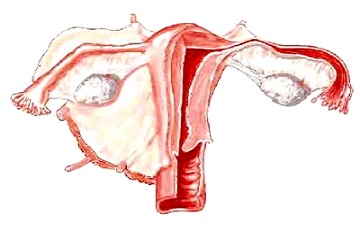 Những bất thường ở tử cung có thể dẫn đến vô sinh​ 