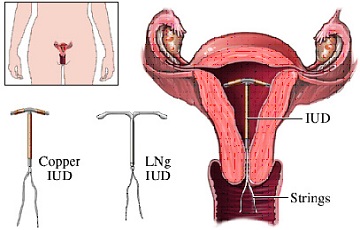 Những thay đổi của cơ thể khi tháo vòng tránh thai