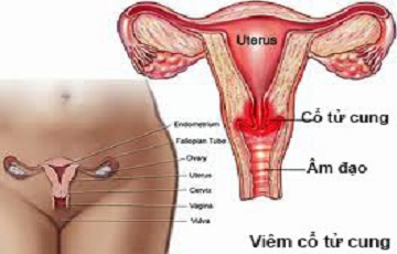 Viêm cổ tử cung có biểu hiện gì?