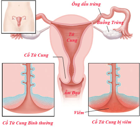 5 nguyên nhân chính gây ra bệnh viêm cổ tử cung