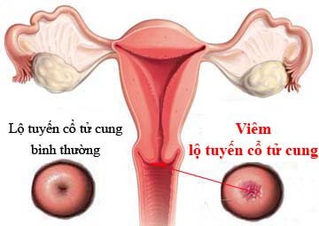 Viêm cổ tử cung phải làm sao - Thủ thuật phục hồi cổ tử cung ít xâm lấn ICR công nghệ Mỹ