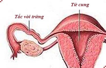 Tắc vòi trứng thủ phạm gây vô sinh ở phụ nữ
