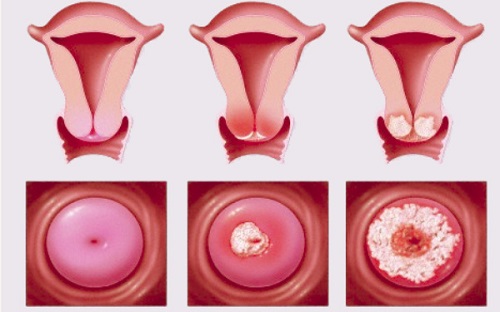 Viêm lộ tuyến cổ tử cung có gây vô sinh?