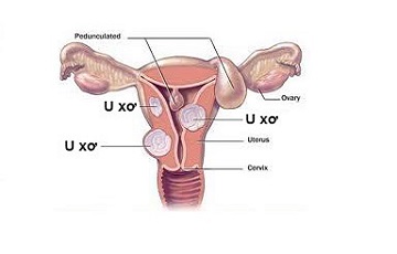 bệnh lý bất thường ở tử cung gây vô sinh cho nữ giới​ 