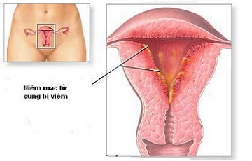 Các bệnh ở tử cung dẫn đến vô sinh ở nữ giới