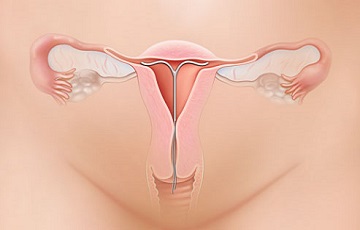 Dính buồng tử cung nguyên nhân gây vô sinh nữ