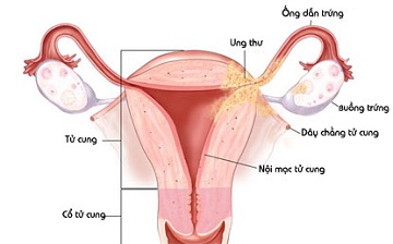 Tổng quan về vô sinh do tử cung