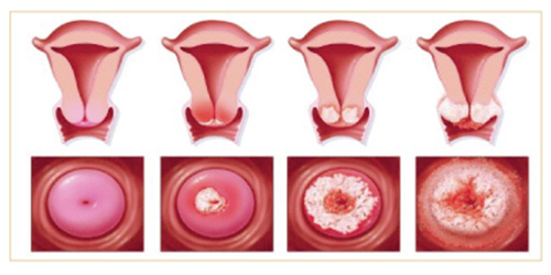 Viêm lộ tuyến cổ tử cung là nguyên nhân gây vô sinh