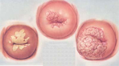 Viêm lộ tuyến cổ tử cung gây ra những hậu quả gì?