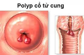 Cách điều trị bệnh Polyp cổ tử cung