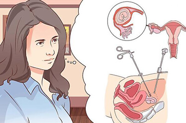 Phá thai an toàn là như thế nào?